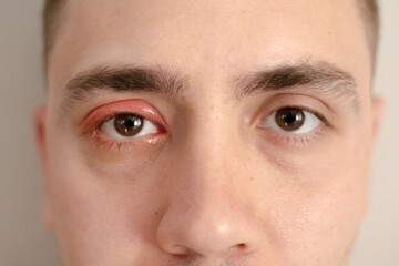 A close-up portrait of a man with swollen and reddened eyes, indicating an eye infection and...
