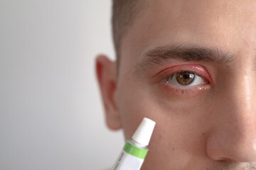 A close-up of a man's eye affected by conjunctivitis, showcasing an eye infection in a human body...