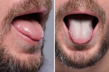 Man showing his tongue before and after cleaning procedure, closeup. Tongue coated with plaque on...