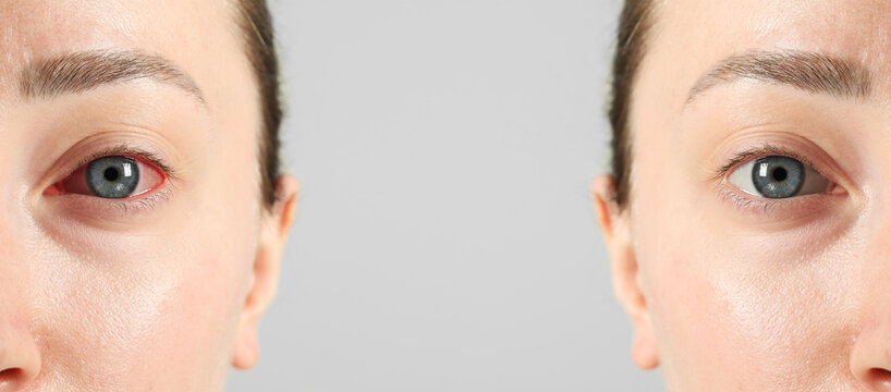 Before and after conjunctivitis treatment. Photos of woman with red and healthy eyes, collage