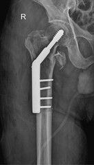Fixation Framework: Fractured Femur X-Ray Analysis
