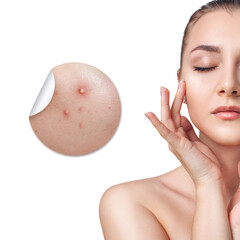 Young woman with zoom circle before and after acne treatment.