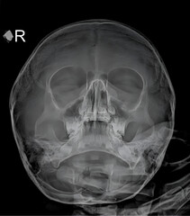 Pediatric Perspectives: Insightful Child Sinus X-Ray Images.