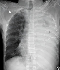 chest x ray radiograph showing left ling collapse 