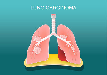 Lung carcinoma. Cancer. Tumors metastasize,