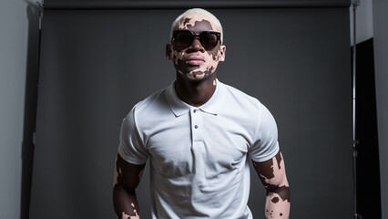 young male fashion model with vitiligo skin condition wearing black sunglasses and white polo t-shirt, professional studio photography with grey background, diverse model