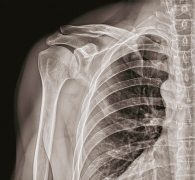 X ray radiograph right shoulder with many broken ribs and shoulder dislocation rib cage