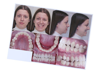 Photos of woman and her teeth from different sides isolated on white