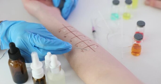 Immunologist performs allergy skin test on a patient arm