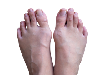 Pieds hallux valgus, sur fond transparent