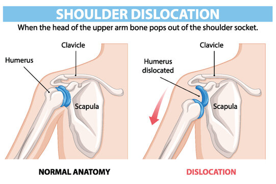 Comparison of normal and dislocated shoulder anatomy
