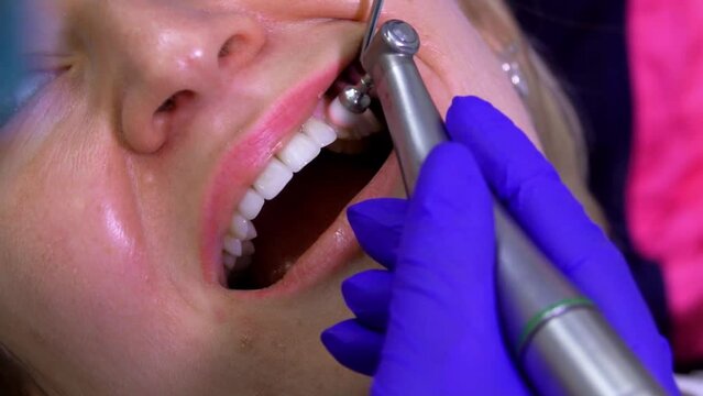 close-up Dentist polishes patient's teeth with a machine. High quality FullHD footage