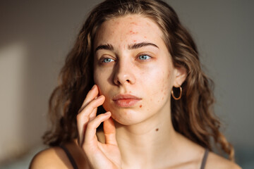 Young woman with acne problem. Dermatology, cosmetology, skin care. Natural skin.