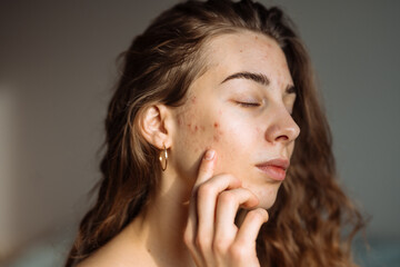 Young woman with acne problem. Dermatology, cosmetology, skin care. Natural skin.