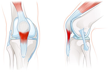 Patellar tendonitis. Jumper's knee. Illustration