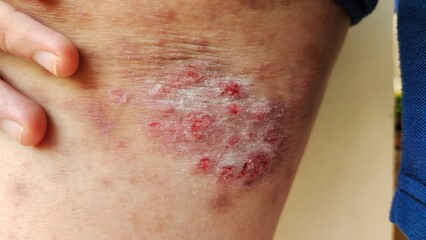 Fototapeta premium close up of a patient, showing the rash hives allergy and inflammation skin, reaction and urticaria on the leg of the woman, health care and medical concept.