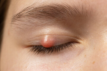 Chalazion on the eyelid of girl macro. Demodicosis mite diseas, demodex. Eye of girl with stye...