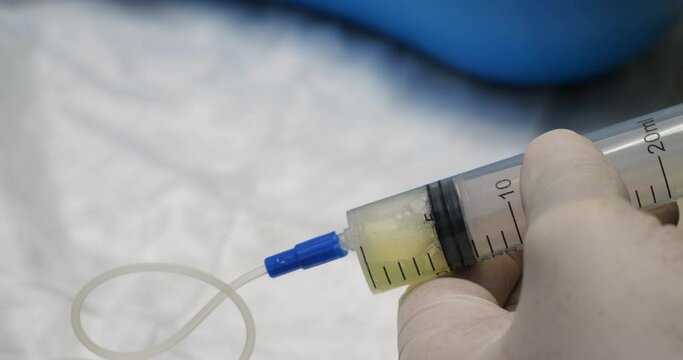 Close-up of a veterinarian drawing ascites fluid from the animal's abdomen into a syringe through a catheter. The doctor collects ascites fluid from the pet for laboratory testing.