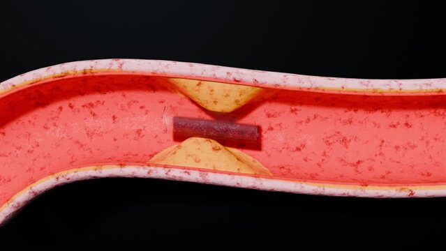 Blocked Artery, Collapsed balloon angioplasty procedure with Coronary stent in vein, blood flow  circulation, vessels, cholesterol fat or atheroma blocking circulation, atherosclerosis, 3d render