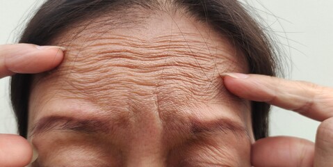 Woman with headache, stress and serious, worried and angry, forehead lines and wrinkles, health...