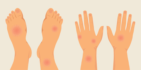 Human legs and hands covered with red rash.