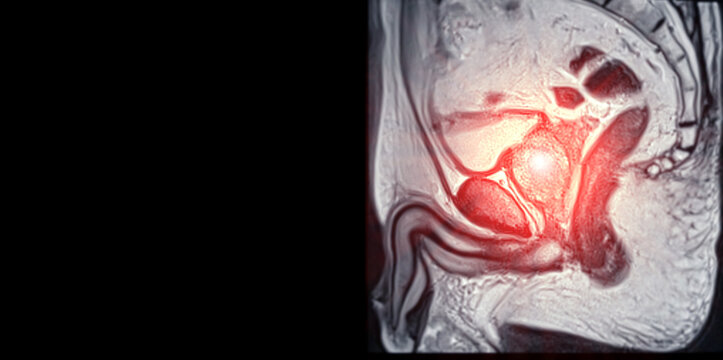 MRI of the prostate gland, revealing an enlarged size.