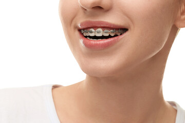 Obraz premium Smiling woman with dental braces on white background, closeup