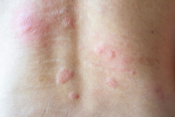 Young asian man itching and scratching on his back from allergic itchy dry skin eczema dermatitis...