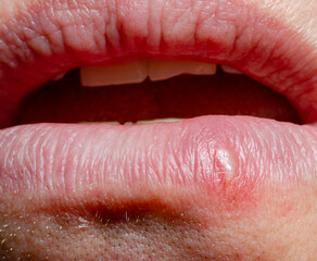 Obraz premium herpes on the lip of an adult man close-up