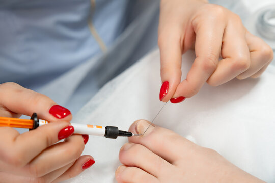 Doctor podologist uses titanium thread to correct the twisted toenail