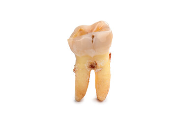 Close-up of tooth with caries isolated on white background. Real human teeth, sick human teeth with clipping path.