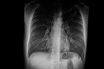Medical themes: X- ray image of patient  with tuberculosis infection