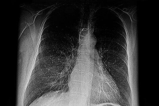 Medical themes: X- Ray image of senior man patient with a sternotomy
