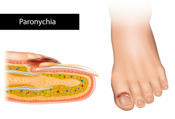 Paronychia is an inflammation of the skin around the nail. Nail Infection