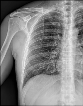 Right shoulder with injuries and rib cage x-ray radiograph