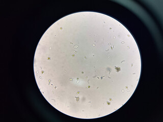 Uric acid crystay in urine.