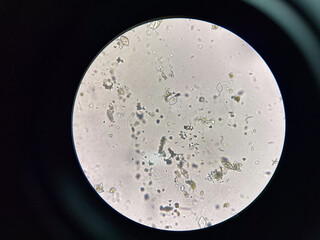 Uric acid crystay in urine.