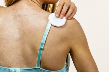 Woman acne on back cleaning skin with cotton