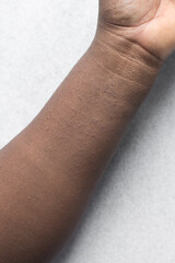 Heat rash on brown skin, prickly heat rash on dark skin, Miliaria on arms