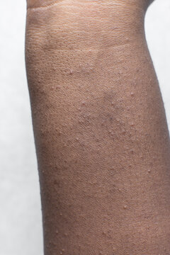 Heat rash on brown skin, prickly heat rash on dark skin, Miliaria on arms