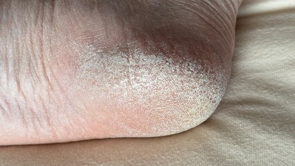 Close-up of the crack on the heel. Small cracks and dry flaky skin on the foot. The concept of foot...