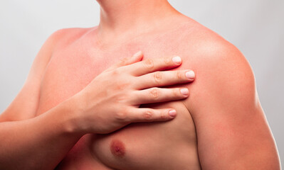 A man with reddened, itchy skin after sunburn on white isolated background. Skin care and...