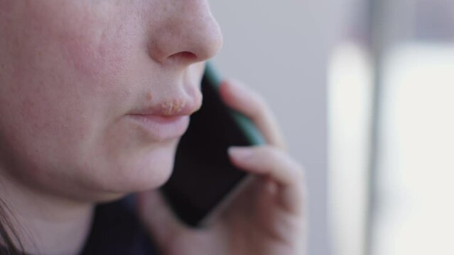 Woman with dry cracked lips and herpes on her mouth speaks on phone. Herpes on lips virus infection discomfort illness Herpes on lips reminder of importance of proper skincare and hygiene