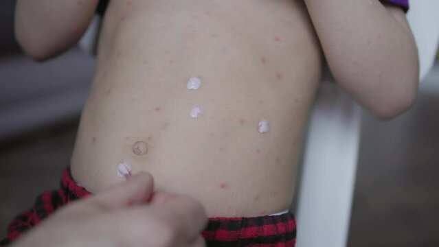 Child affected with chickenpox red spots all over body cotton swab medicine is applied to red spots. Applying medicine to red spots trying to ease discomfort itchy rash Applying medicine chickenpox