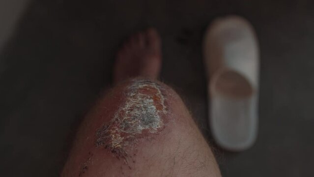 Close-Up Of An Infected Wound On A Knee, Highlighting Medical Concerns And Skin Health. Scabs And Discoloration On The Knee, With A Slipper Visible In The Background.