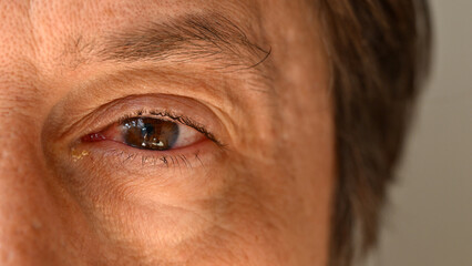 Eye infection, closeup of male eye with conjunctivitis disease