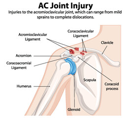 Detailed illustration of shoulder joint anatomy and injuries