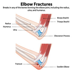 Diagram showing types of elbow fractures