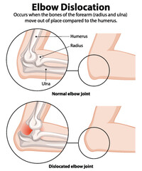 Comparison of normal and dislocated elbow joints