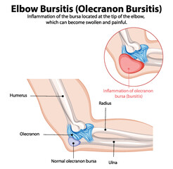 Inflammation of the bursa in the elbow
